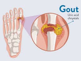 gout | Spectra Vitamins March 26, 2026